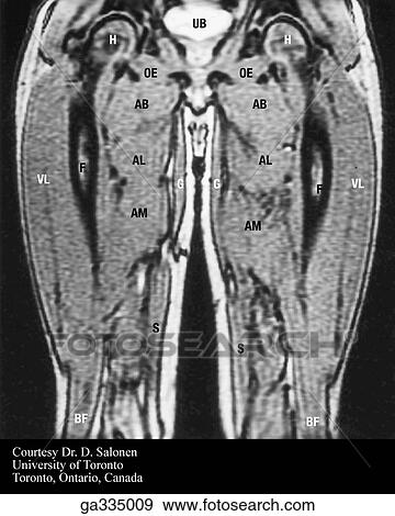 T1 coronal MRIs of lower limb. A. Thigh. View Large Illustration Stock Illustration - T1 coronal MRIs of lower limb. A. Thigh.. Fotosearch