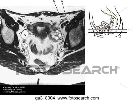 Stock Illustration - Transverse (axial) MRIs of the female pelvis and perineum. A. Insert image indicates level of MRI.. Fotosearch