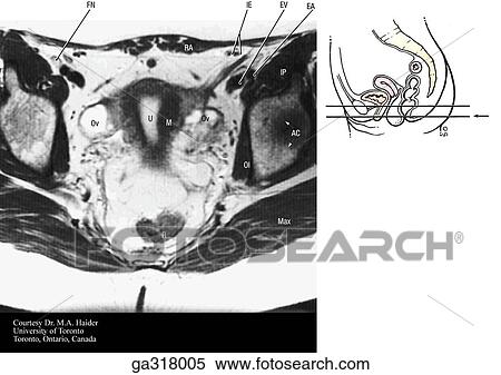 Transverse (axial) MRIs of the female pelvis and perineum. B. Insert image indicates level of MRI. View Large Illustration Stock Illustration - Transverse (axial) MRIs of the female pelvis and perineum. B. Insert image indicates level of MRI.. Fotosearch