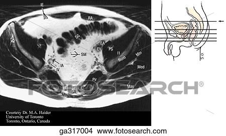 Transverse (axial) MRIs of the male pelvis and perineum. A. Insert image indicates level of MRI. View Large Illustration Stock Illustration - Transverse (axial) MRIs of the male pelvis and perineum. A. Insert image indicates level of MRI.. Fotosearch