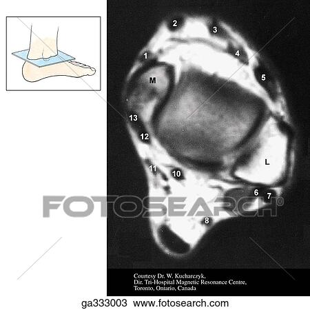 Transverse section and MRI through ankle. B. Transverse MRI (Numbers in B refer to structures labeled in A. ) Insert indicates level of MRI. View Large Illustration Drawing - Transverse section and MRI through ankle. B. Transverse MRI (Numbers in B refer to structures labeled in A. ) Insert indicates level of MRI.. Fotosearch