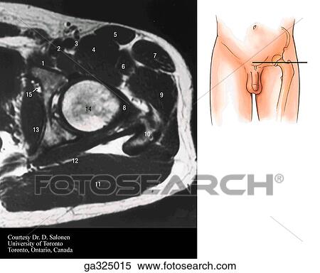 Stock Illustration - Transverse section through thigh at level of hip joint. B. Magnetic resonance image (MRI). (Numbers refer to structures in A. ) Insert image indicates level of MRI.. Fotosearch