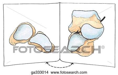 Transverse tarsal joint. B. Bony surface of tarsal joint. This joint includes the talonavicular and calcaneocuboid articulations. The posterior surfaces of the navicular and cuboid bones, and the anterior surfaces of the talus and calcaneus are displayed View Large Illustration Stock Illustration - Transverse tarsal joint. B. Bony surface of tarsal joint. This joint includes the talonavicular and calcaneocuboid articulations. The posterior surfaces of the navicular and cuboid bones, and the anterior surfaces of the talus and calcaneus are displayed . Fotosearch