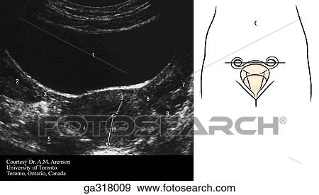 Stock Illustration - Ultrasound scan of female pelvis. A. Transabdominal axial (transverse) scan through uterus and ovaries. Insert image indicates level of MRI.. Fotosearch