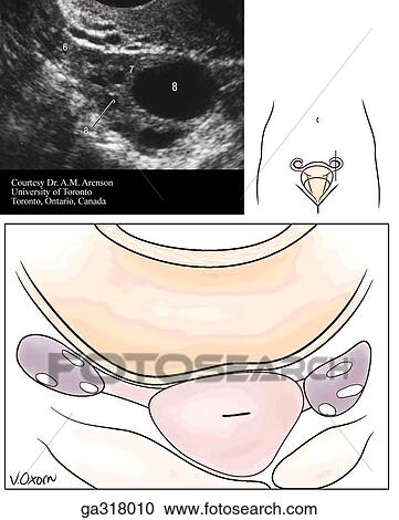 Ultrasound scans of female pelvis. B. Transvaginal sagittal scan on left ovary. The redi line on each orientation drawing indicates the site of the scan. The numbers in the parentheses correspond to labels on the ultrasound scans. In B, note the F-dominan View Large Illustration Clipart - Ultrasound scans of female pelvis. B. Transvaginal sagittal scan on left ovary. The redi line on each orientation drawing indicates the site of the scan. The numbers in the parentheses correspond to labels on the ultrasound scans. In B, note the F-dominan. Fotosearch