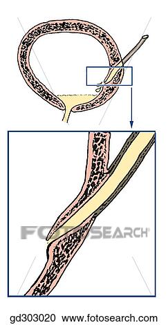 Ureterovesical junction and ostium (opening) of the ureter into the interior of the bladder. View Large Illustration Clipart - Ureterovesical junction and ostium (opening) of the ureter into the interior of the bladder.. Fotosearch