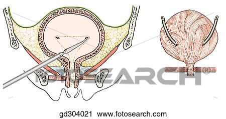 Urinary bladder and its support on the female pelvic floor. View Large Illustration Clip Art - Urinary bladder and its support on the female pelvic floor.. Fotosearch