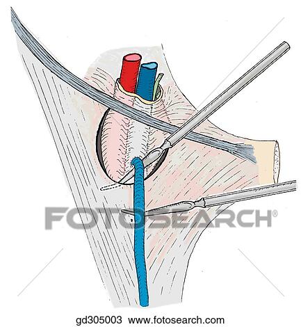 Drawing - Use a probe to find and to define the margin of the saphenous opening.. Fotosearch