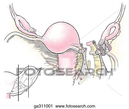 Uterus and broad ligament. B. Broad ligament, anterolateral view. Two paramedian sections show "mesenteries" with the prefix "meso. " Salpinx is Greek for trumpet or tube, metro for uterus. Insert image indicates level of dissection. View Large Illustration Clip Art - Uterus and broad ligament. B. Broad ligament, anterolateral view. Two paramedian sections show "mesenteries" with the prefix "meso. " Salpinx is Greek for trumpet or tube, metro for uterus. Insert image indicates level of dissection. . Fotosearch