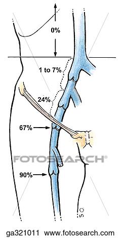 Valves of proximal part of femoral and great saphenous veins, anterior view. B. Percentage incidence of valves between the proximal femoral vein and inferior vena cava. View Large Illustration Clip Art - Valves of proximal part of femoral and great saphenous veins, anterior view. B. Percentage incidence of valves between the proximal femoral vein and inferior vena cava.. Fotosearch