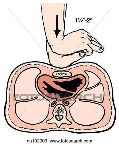 クロスセクション の 胸郭 において レベル の 心 で 手を握り締めた 適用 胸 Compression イラスト Nu Fotosearch