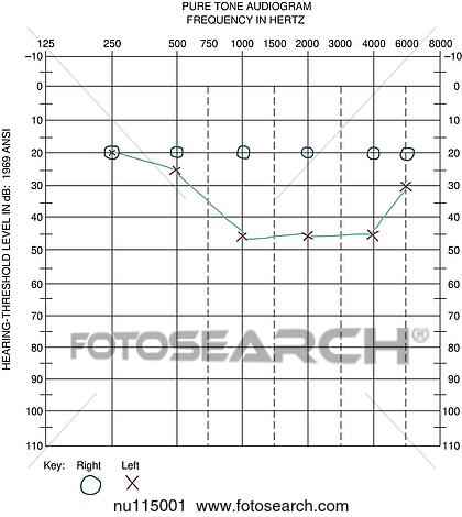 Clip Art - An audiogram done as a screening procedure. Notice that hearing is normal in right ear (all frequencies are heard at the 20-dB level).. Fotosearch