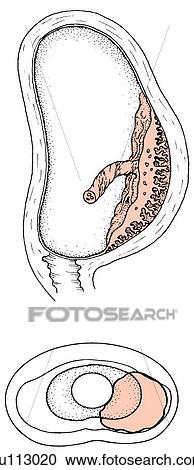 An example of low placental placement on uterine wall. Uterus and cervix in sagittal section (top) and schematically from below (bottom). View Large Illustration Clipart - An example of low placental placement on uterine wall. Uterus and cervix in sagittal section (top) and schematically from below (bottom).. Fotosearch