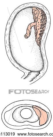 An example of normal placental placement high on uterine wall. Uterus and cervix in sagittal section (top) and schematically from below (bottom). View Large Illustration Stock Illustration - An example of normal placental placement high on uterine wall. Uterus and cervix in sagittal section (top) and schematically from below (bottom).. Fotosearch