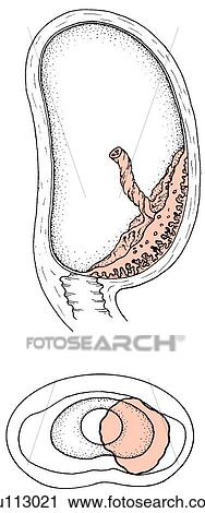 Clip Art - An example of partial placenta previa where placenta partially obiterates cervical os but does not cover it. Uterus and cervix in sagittal section (top) and schematically from below (bottom).. Fotosearch