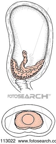 An example of total placenta previa where placenta obiterates cervical os, totally covering it. Uterus and cervix in sagittal section (top) and schematically from below (bottom). View Large Illustration Drawing - An example of total placenta previa where placenta obiterates cervical os, totally covering it. Uterus and cervix in sagittal section (top) and schematically from below (bottom).. Fotosearch