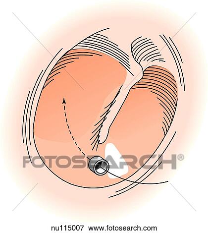 Stock Illustration - An otoscopic view of an eardrum with a myringotomy tube in place. The tube provides air to the middle ear to help prevent serious otitis media.. Fotosearch