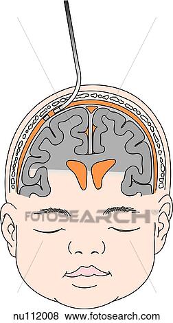 Stock Illustration - Anterior view of head and face of infant, skull and brain are illustrated. A fiberoptic sensor is implanted into the epidural space.. Fotosearch