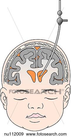 Stock Illustration - Anterior view of head and face of infant, skull and brain are illustrated. An intraventricular catheter has been inserted through the anterior fontanelle and threaded into the lateral ventricle.. Fotosearch