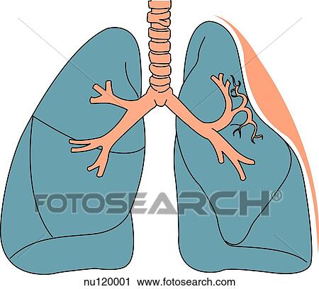 Clip Art - Anterior view of lungs suffering from atelectasis caused by compression of lung tissue.. Fotosearch