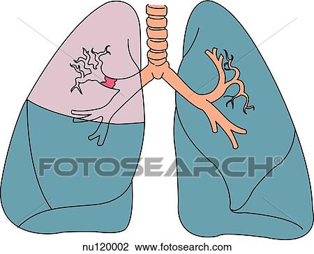 Anterior view of lungs suffering from atelectasis caused by obstruction. An occlusion can be seen in right Eparteral bronchus. View Large Illustration Drawing - Anterior view of lungs suffering from atelectasis caused by obstruction. An occlusion can be seen in right Eparteral bronchus.. Fotosearch