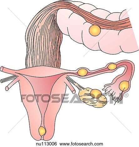 Stock Illustration - Anterior view of the uterus, uterine (Fallopian) tube, and ovary with possible sites of ectopic pregnancies shown in yellow.. Fotosearch