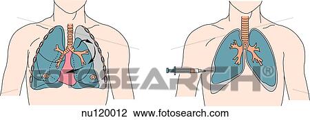 Anterior view of thoracic area of male chest showing lungs and heart within ribcage. Left: tear in tracheobronchial tree has caused air to move into pleural space. Right: syringe aspirates air from pleural space to allow lung to reexpand. View Large Illustration Drawing - Anterior view of thoracic area of male chest showing lungs and heart within ribcage. Left: tear in tracheobronchial tree has caused air to move into pleural space. Right: syringe aspirates air from pleural space to allow lung to reexpand.. Fotosearch