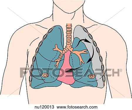 Anterior View Of Thoracic Area Of Male Chest Showing Lungs And Heart Within Ribcage Left Tear In Tracheobronchial Tree Has Caused Air To Move Into Pleural Space Drawing Nu120013 Fotosearch