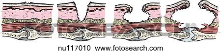 Cross-section of skin showing 4 stages of pressure sore and ulcer classification. Stage 1: inflammation, redness of epidermis. Stage 2: loss of epidermis, damage to dermis. Stage 3: involvement of subcutaneous tissue. Stage 4: damage to tendon, mus View Large Illustration Clipart - Cross-section of skin showing 4 stages of pressure sore and ulcer classification. Stage 1: inflammation, redness of epidermis. Stage 2: loss of epidermis, damage to dermis. Stage 3: involvement of subcutaneous tissue. Stage 4: damage to tendon, mus. Fotosearch