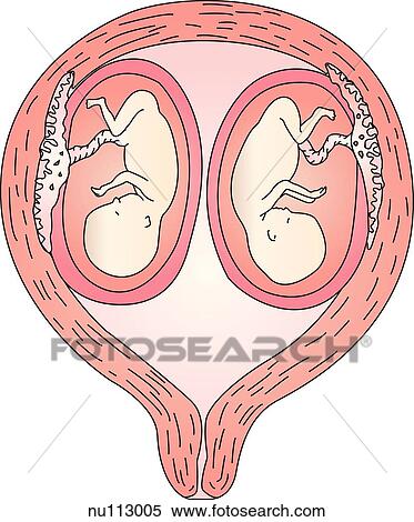 Dizygotic 双子 提示 ２ 胎盤 ２ Chorions そして ２ Amnions イラスト Nu Fotosearch