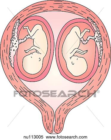 Dizygotic twins showing two placentas, two chorions, and two amnions. View Large Illustration Stock Illustration - Dizygotic twins showing two placentas, two chorions, and two amnions.. Fotosearch