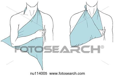 Drawings of male torso and right arm with sling. Left: sling on chest with one end around neck on unaffected side, arm across sling. Right: lower corner has been knotted at side of neck, material at elbow folded and secured. View Large Illustration Stock Illustration - Drawings of male torso and right arm with sling. Left: sling on chest with one end around neck on unaffected side, arm across sling. Right: lower corner has been knotted at side of neck, material at elbow folded and secured.. Fotosearch