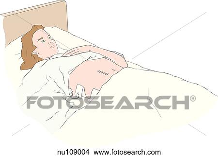 Stock Illustration - Female patient with raised gown exposing abdominal wound. Montgomery straps can been seen.. Fotosearch