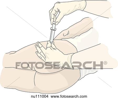 Gloved hands aspirating syringe at dorsogluteal site of injection. View Large Illustration Stock Illustration - Gloved hands aspirating syringe at dorsogluteal site of injection.. Fotosearch
