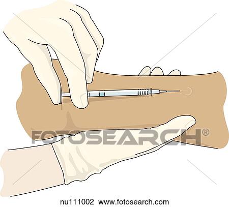 Gloved hands injecting medication into intradermal site on inside of wrist, wheal appears where medication is deposited right under skin. View Large Illustration Drawing - Gloved hands injecting medication into intradermal site on inside of wrist, wheal appears where medication is deposited right under skin.. Fotosearch