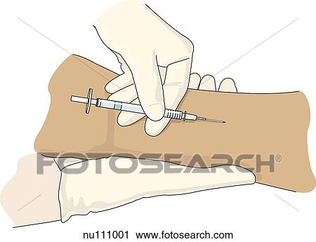 Gloved hands inserting needle almost level with the skin of the inside of the wrist. View Large Illustration Clip Art - Gloved hands inserting needle almost level with the skin of the inside of the wrist.. Fotosearch