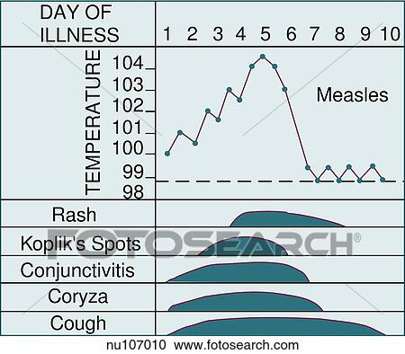 Clipart - Graphic demonstrating the various characteristics of measles, an acute exanthem characterized by rash.. Fotosearch