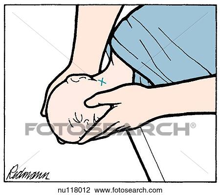 Head of infant shown restrained between two adult hands. Child's head is extended over edge of table. View Large Illustration Drawing - Head of infant shown restrained between two adult hands. Child's head is extended over edge of table.. Fotosearch