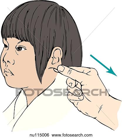Stock Illustration - Health care professional's hand is shown pulling pinna of ear of a child patient posteriorly and inferiorly. Picture illustrates technique of irrigation of the external auditory canal in a child.. Fotosearch