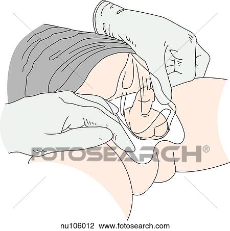 Drawing - Illustration demonstrating the proper technique of using a urine collector to collect urine in an infant. The trick to making the collector adhere is to be certain that the child's skin is dry.. Fotosearch