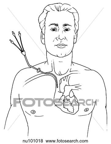 Illustration of male head and torso with heart and its major branches visible. A triple-lumen venous catheter is in place. View Large Illustration Stock Illustration - Illustration of male head and torso with heart and its major branches visible. A triple-lumen venous catheter is in place.. Fotosearch