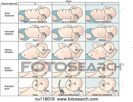 Illustration showing the grading of neonatal respiratory distress based on the Silverman-Anderson index. A controlled clinical trial of effects of water mist on obstructive respiratory signs, death rate, and necroscopy findings among premature infants. View Large Illustration Stock Illustration - Illustration showing the grading of neonatal respiratory distress based on the Silverman-Anderson index. A controlled clinical trial of effects of water mist on obstructive respiratory signs, death rate, and necroscopy findings among premature infants.. Fotosearch