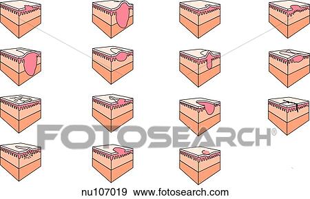 Illustration showing the various types off primary and secondary skin lesions and their characteristics. View Large Illustration Stock Illustration - Illustration showing the various types off primary and secondary skin lesions and their characteristics.. Fotosearch