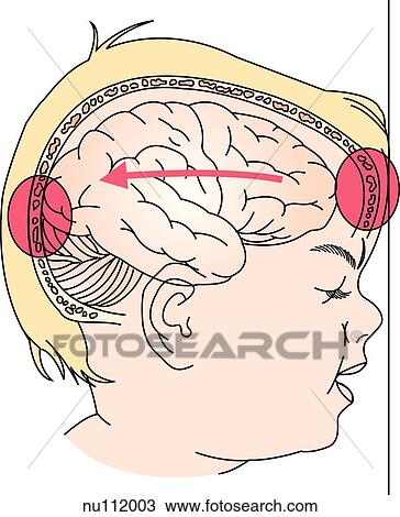 Drawing - Image on demonstrates how in a contracoup injury a blow to the rear of the skull causes the brain to first hit the anterior skull and then recoil and strike the posterior skull as well, injurying it twice.. Fotosearch