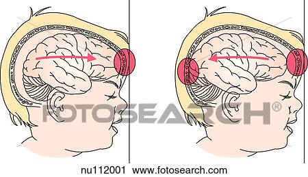Clip Art - Image on left demonstrates how in a coup injury a blow to the rear of the skull results in an injury to the anterior of the brain. In a contracoup injury (right), the brain recoils and strikes the posterior skull as well, injurying it twice.. Fotosearch