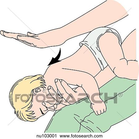 Clip Art - Infant is held lying face down along the length of an adult thigh while a hand administers back blows in the proper direction to relieve a complete foreign body airway obstruction.. Fotosearch