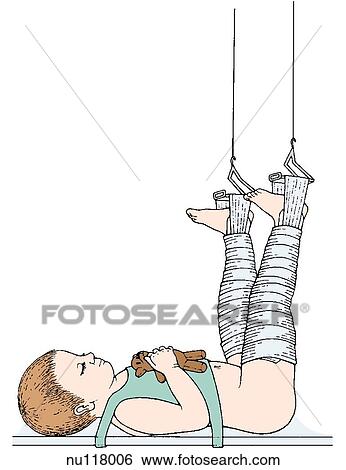 Stock Illustration - Lateral view of child in Bryant's traction. Patient lies supine with arms on chest holding toy, wrapped legs are extended at right angles to body, buttocks and hips slightly elevated by bilateral vertical traction pull.. Fotosearch
