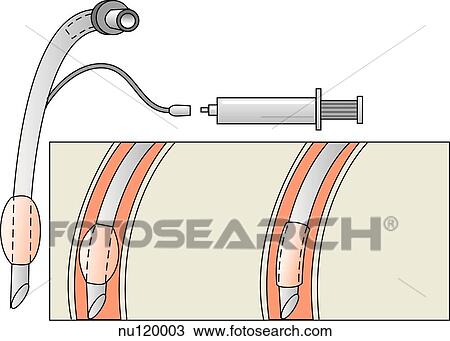 Drawing - Left image shows parts of a cuffed endotracheal tube. Middle image shows tube in place with the cuff inflated. Right image shows tube in place with cuff deflated.. Fotosearch