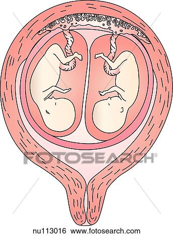 Monozygotic twins showing one placentas, one chorions, and two amnions. View Large Illustration Stock Illustration - Monozygotic twins showing one placentas, one chorions, and two amnions.. Fotosearch