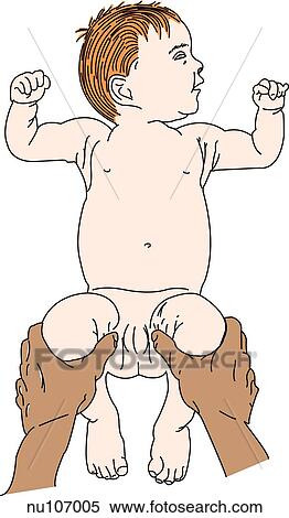 Nurse illiciting a positive Barlow sign. Infant supine, knees to 90 degrees at the hips. With middle finger over greater trochanter of femur and thumb on inside of thigh, hips are adducted with backward pressure. View Large Illustration Stock Illustration - Nurse illiciting a positive Barlow sign. Infant supine, knees to 90 degrees at the hips. With middle finger over greater trochanter of femur and thumb on inside of thigh, hips are adducted with backward pressure.. Fotosearch